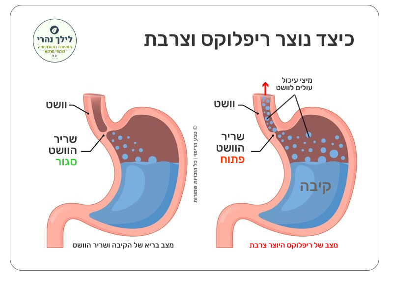 כאבים בחזה  - איך נוצר ריפלוקס