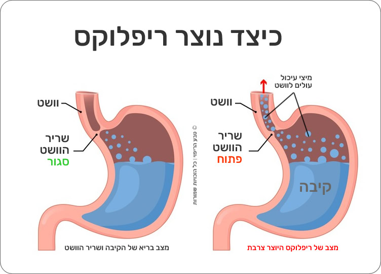 ריפלוקס ובקע סרעפתי
